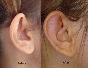 جراحی زیبایی گوش (اتوپلاستی)
