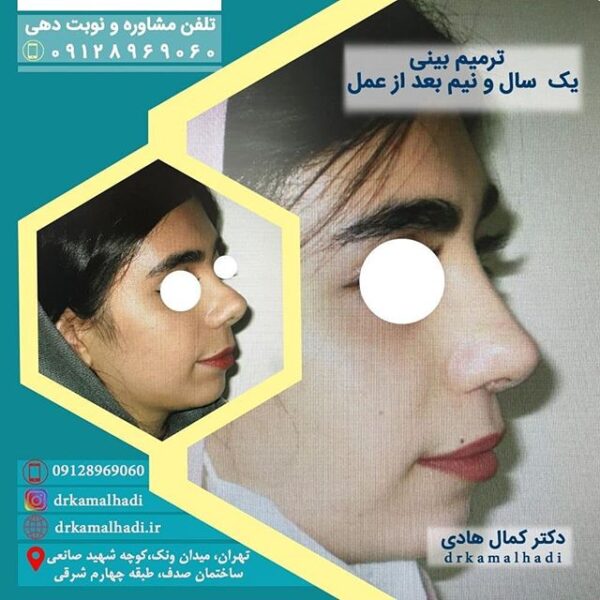 بهترین جراح بینی استخوانی در ایران