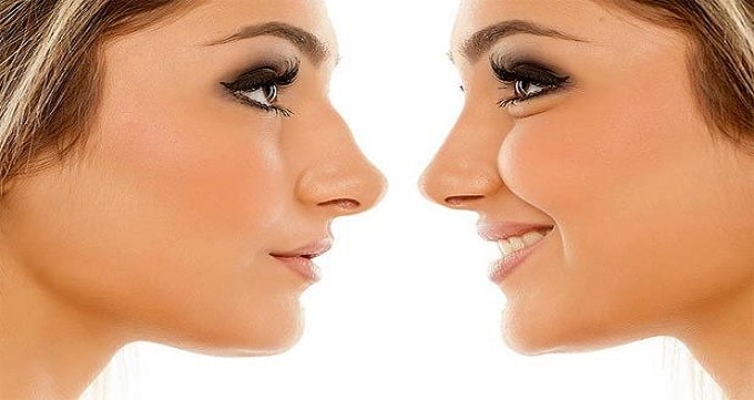 هزینه جراحی بینی استخوانی